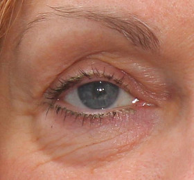 Eye bag Blepharoplasty